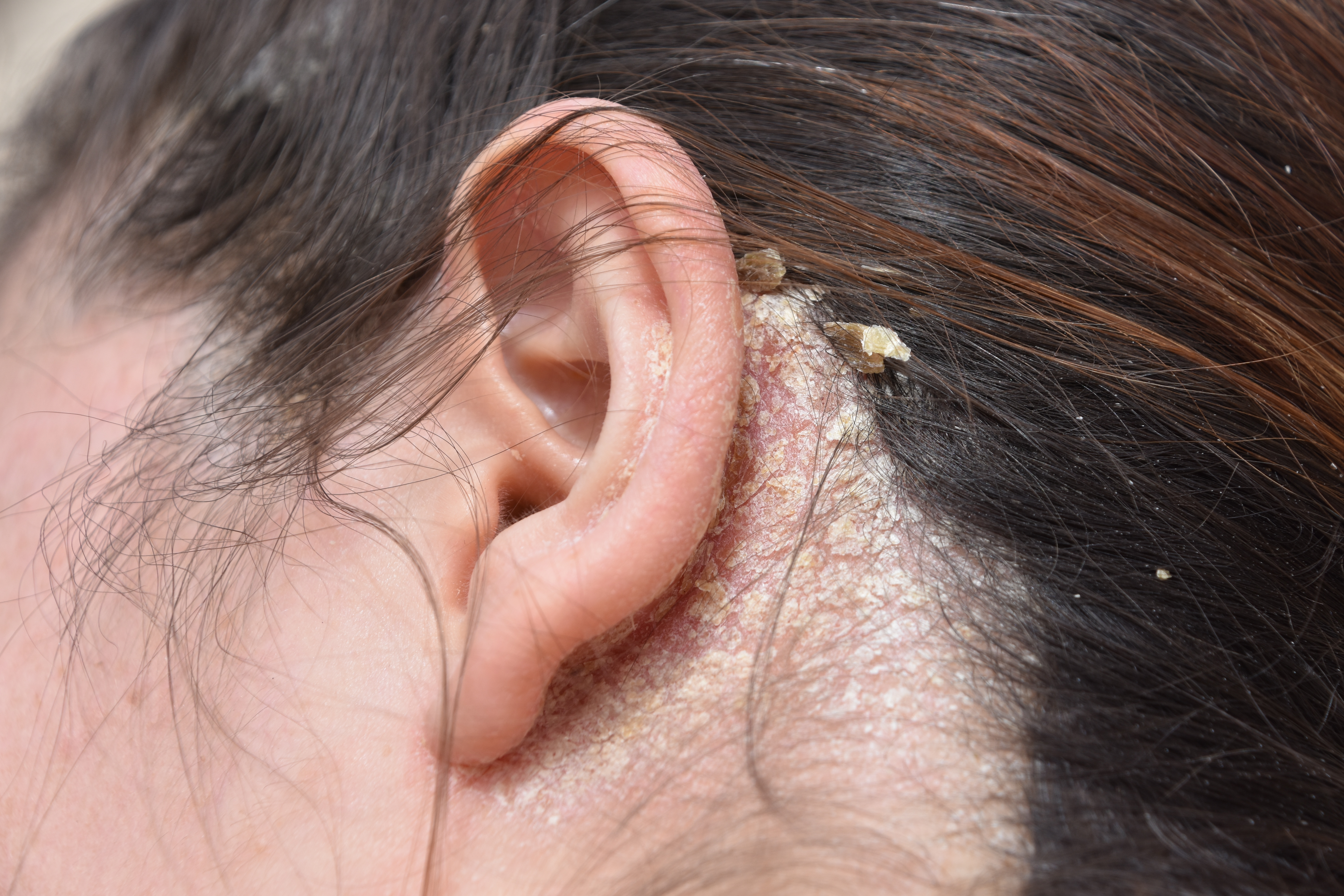 Dry Flaky Skin In Ears Causes