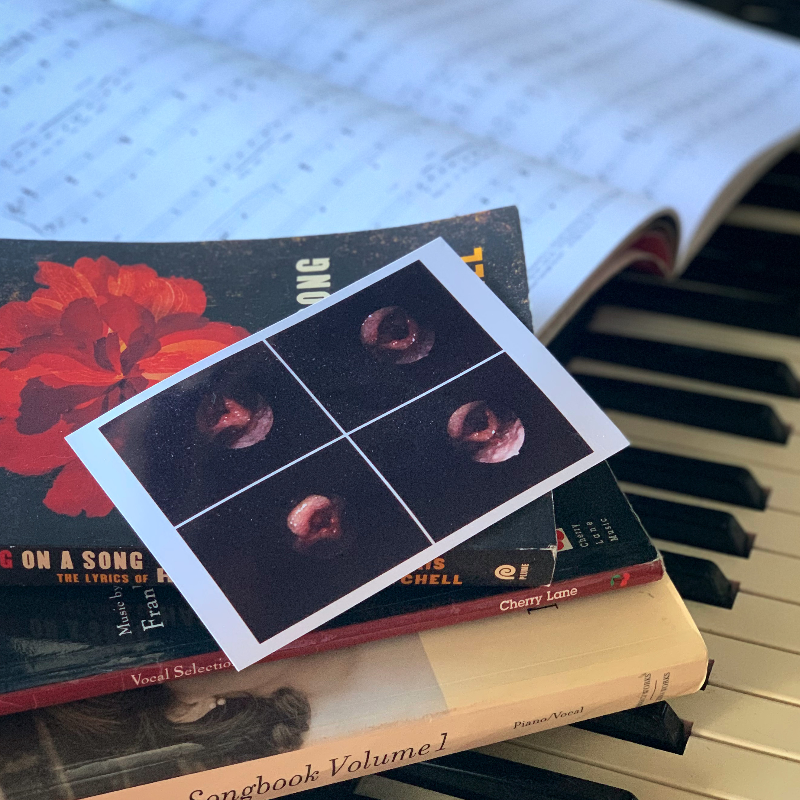 Thyroidectomy For Singers Thyroid Removal And Vocal Cords