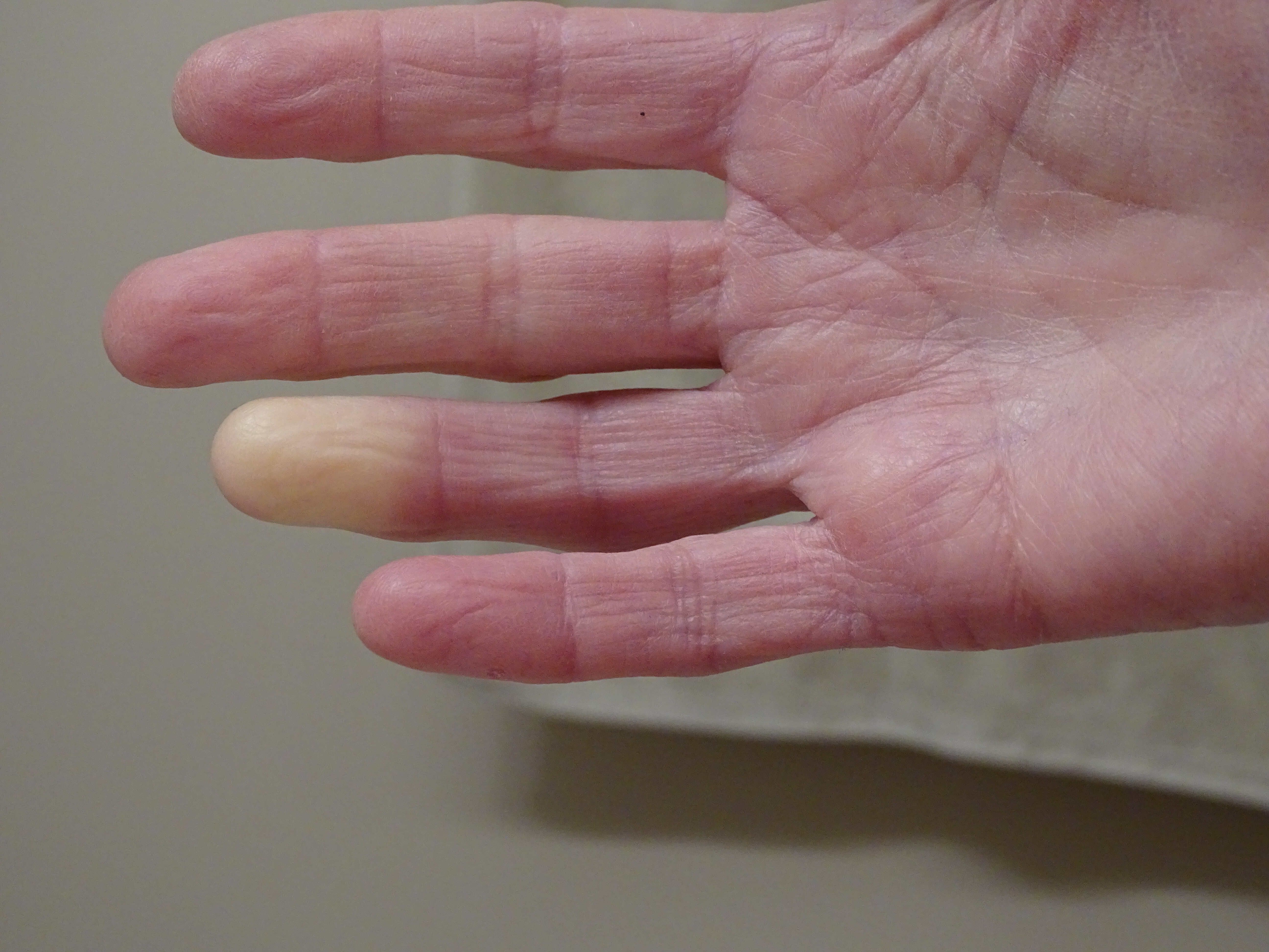 Raynaud's Phenomenon: Frequently Asked Questions