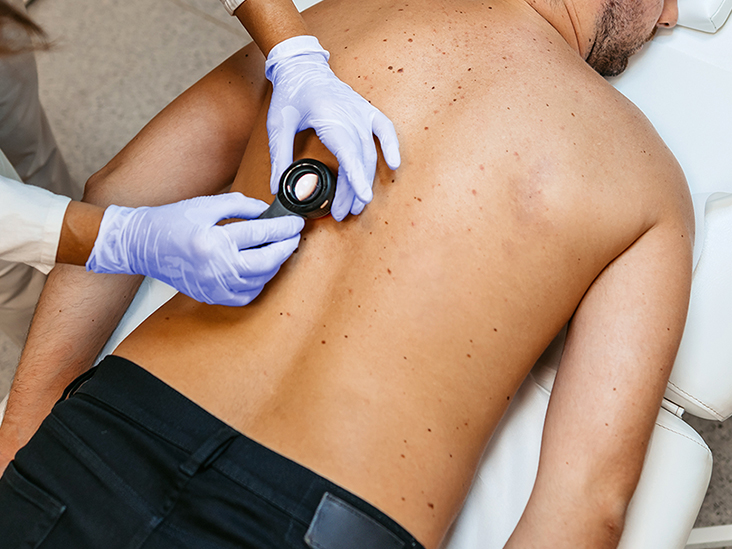 Melanoma vs Blood Blister: Symptoms, Causes, When to See a Doctor - Vimarsana News